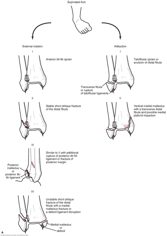 Text 족관절 골절 : Ankle Fracture by SungHun.Kim : 네이버 블로그