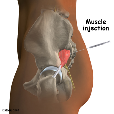 Steroid glute injection pain