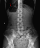 gastric bubble in diabetic coma x ray