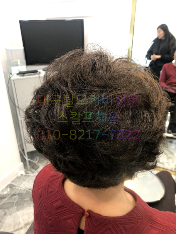 대구가발스칼프채움 이미지